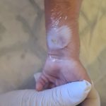 Péče o kůži, stomie a invazivní vstupy u dětí bude stále potřebnější