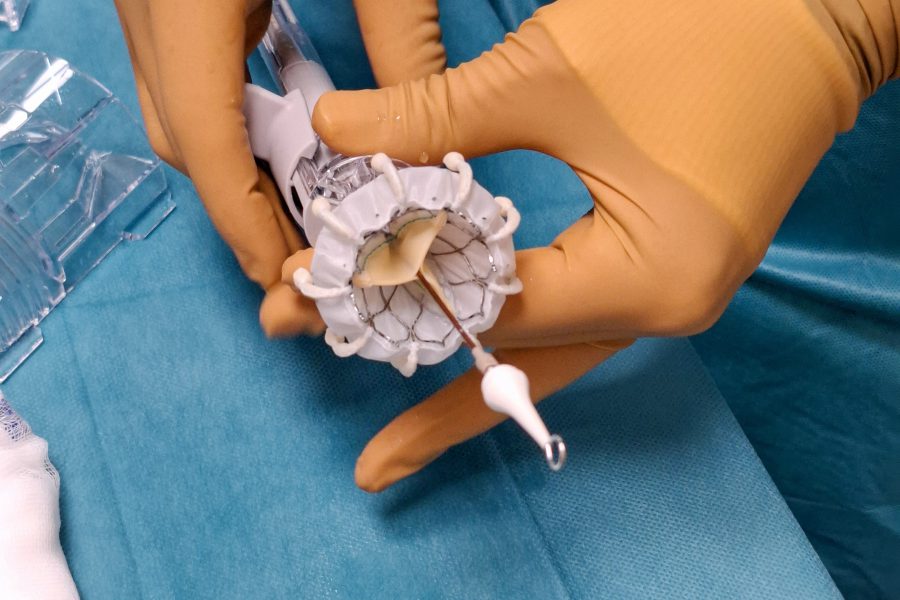 Unikátní operace srdce ve VFN! Naši lékaři jako první v Česku vyměnili pacientovi nefunkční trojcípou srdeční chlopeň za umělou katetrizační cestou