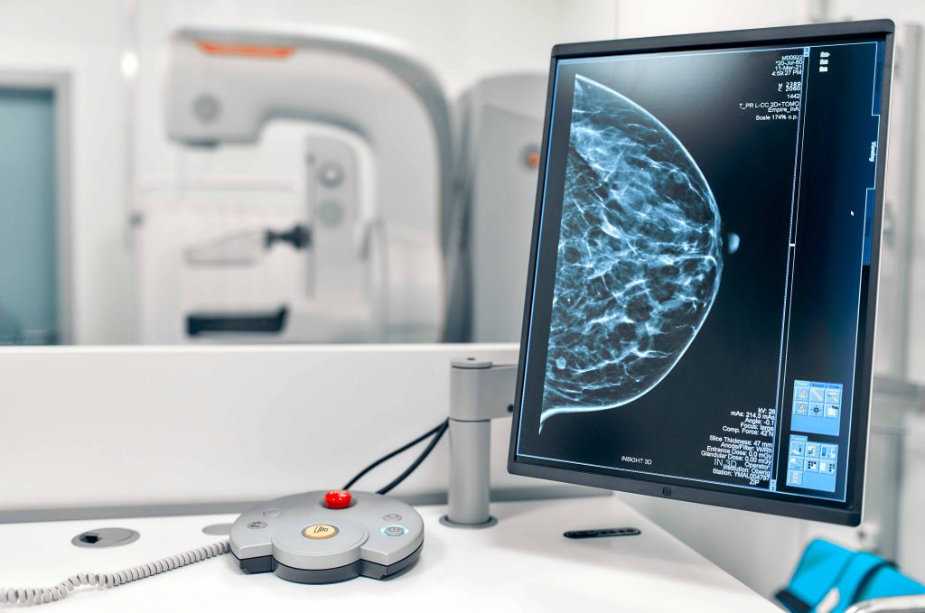 Mohou ženy chodit na preventivní mamografické vyšetření od 1. července bez žádanky? Ano, ale jen ve výjimečných případech!