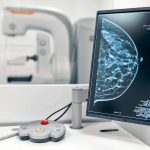 Mohou ženy chodit na preventivní mamografické vyšetření od 1. července bez žádanky? Ano, ale jen ve výjimečných případech!